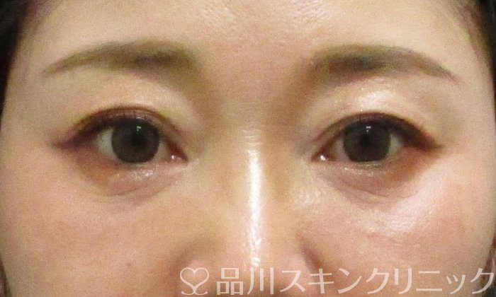 症例NO.70362のBEFORE写真