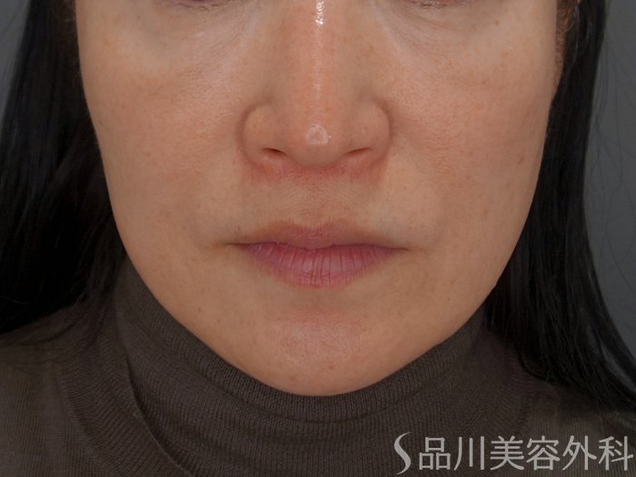 症例NO.74759のBEFORE写真