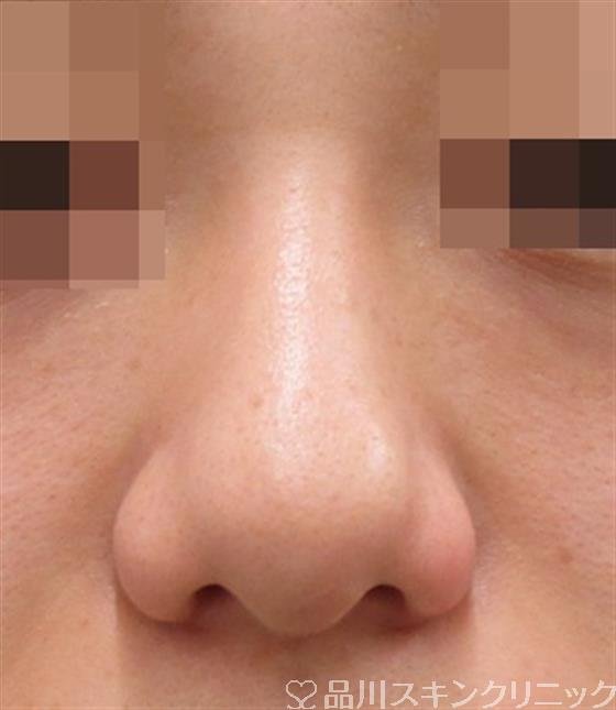 症例NO.40662のBEFORE写真