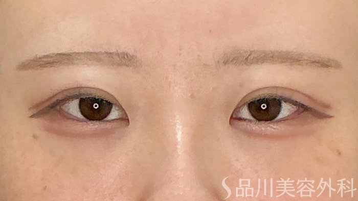 症例NO.71761のAFTER写真