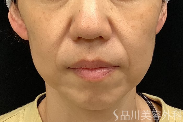 症例NO.67778のBEFORE写真