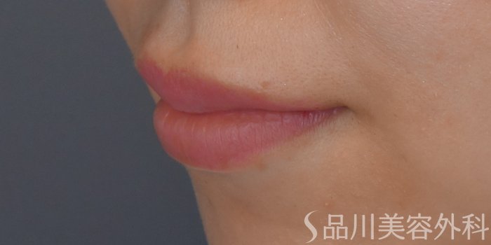 症例NO.71350のAFTER写真