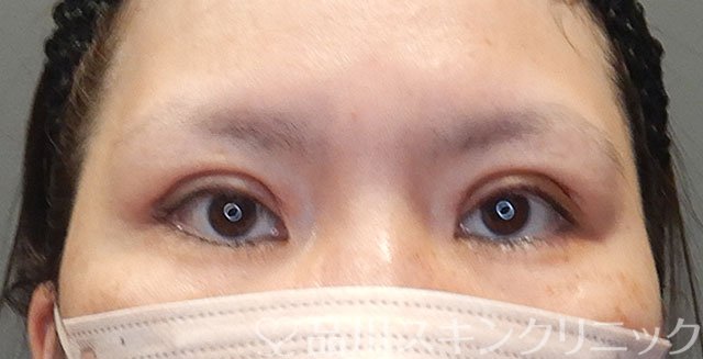 症例NO.75077のAFTER写真