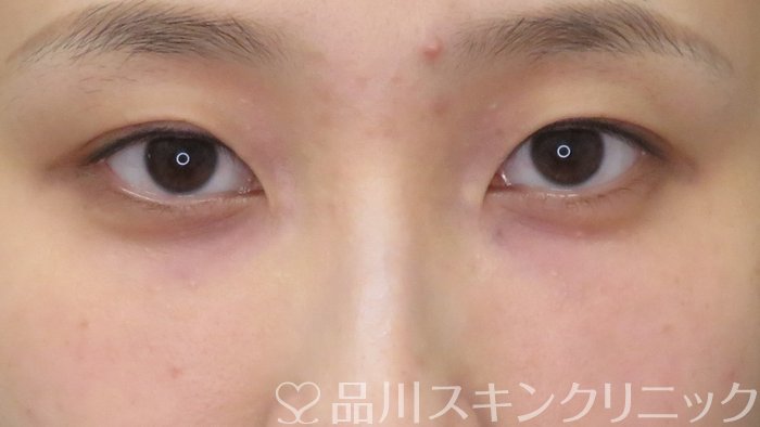 症例NO.72521のAFTER写真