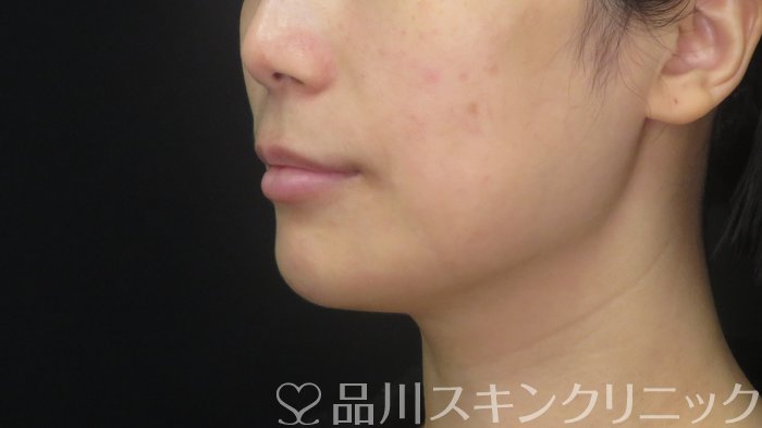 症例NO.72354のBEFORE写真