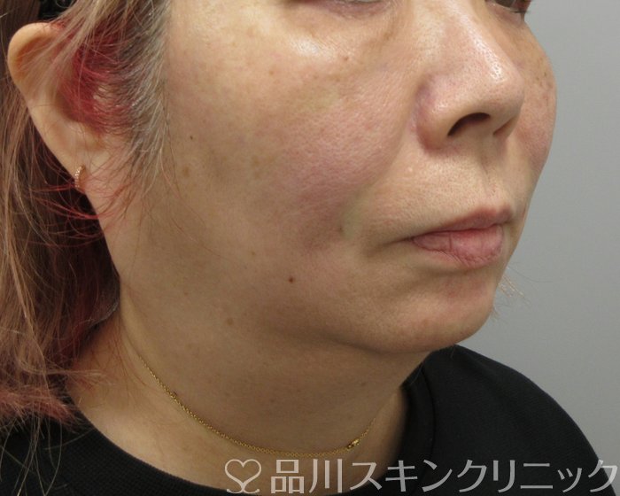 症例NO.73152のAFTER写真