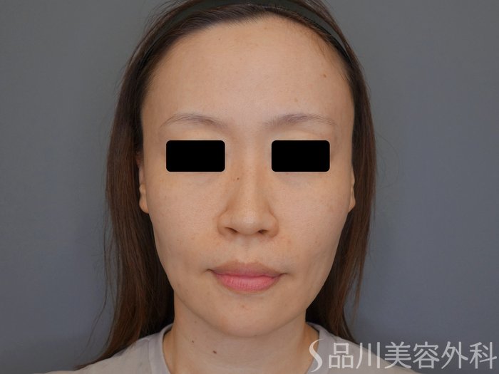 症例NO.71174のBEFORE写真