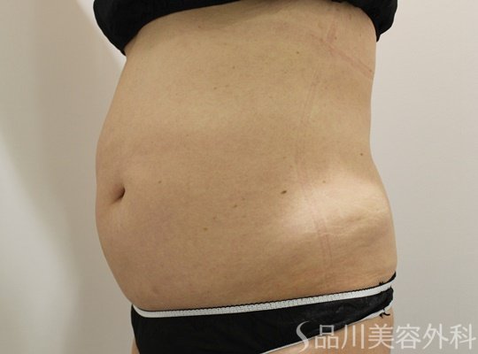 症例NO.73217のBEFORE写真