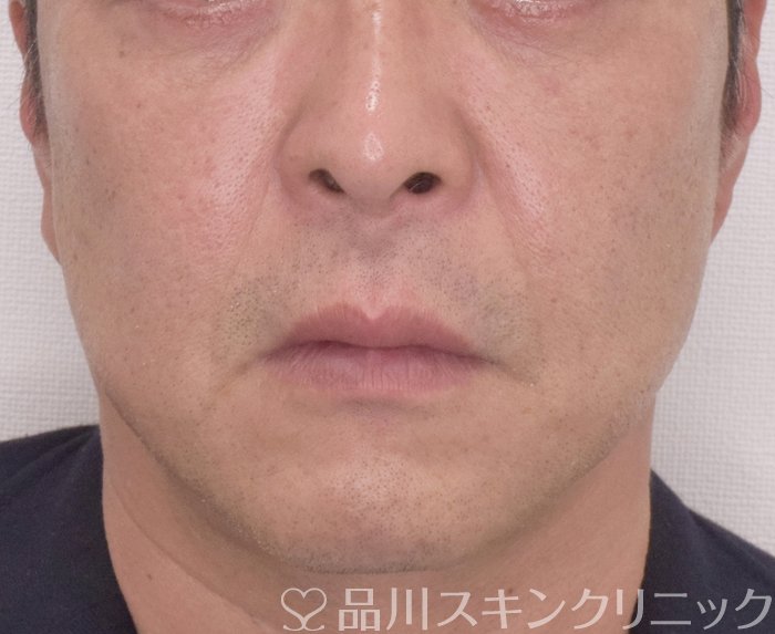 症例NO.65369のAFTER写真
