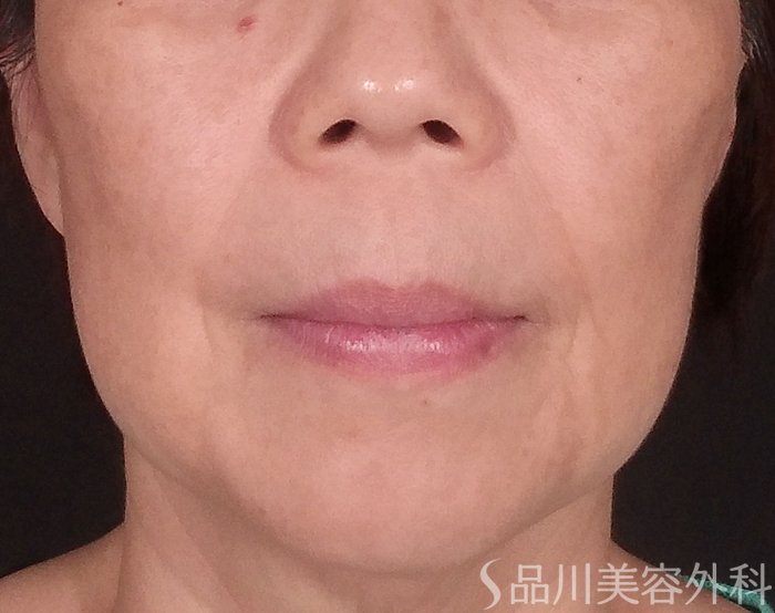 症例NO.70312のBEFORE写真