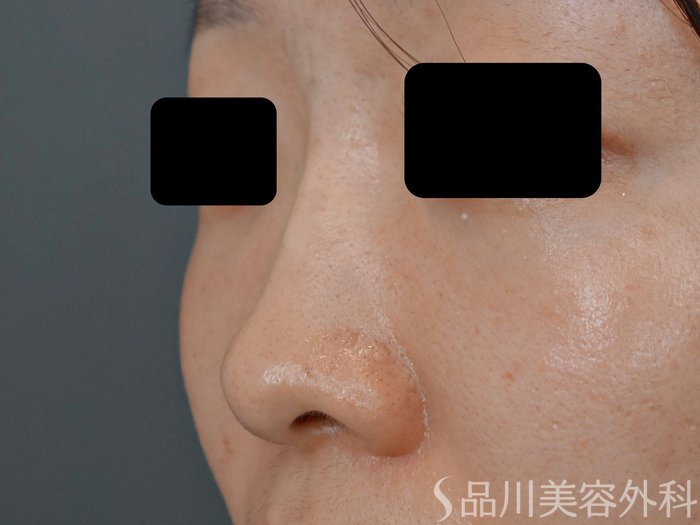 症例NO.71882のAFTER写真