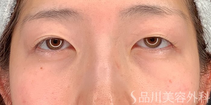 症例NO.68723のBEFORE写真
