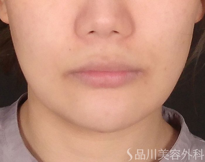 症例NO.70069のBEFORE写真