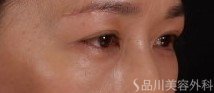 症例NO.71521のAFTER写真