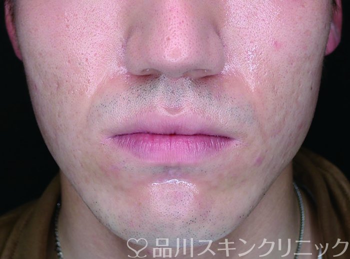 症例NO.74024のAFTER写真