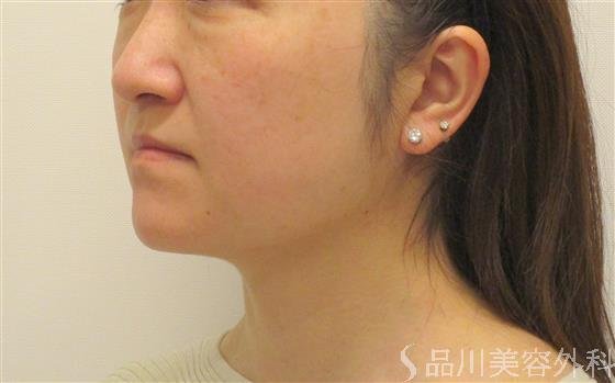 症例NO.60375のBEFORE写真