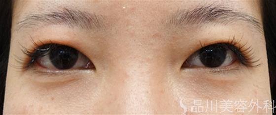 症例NO.46735のBEFORE写真