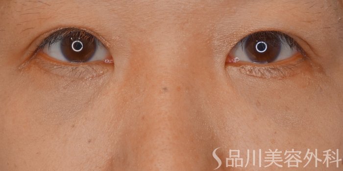 症例NO.62331のAFTER写真