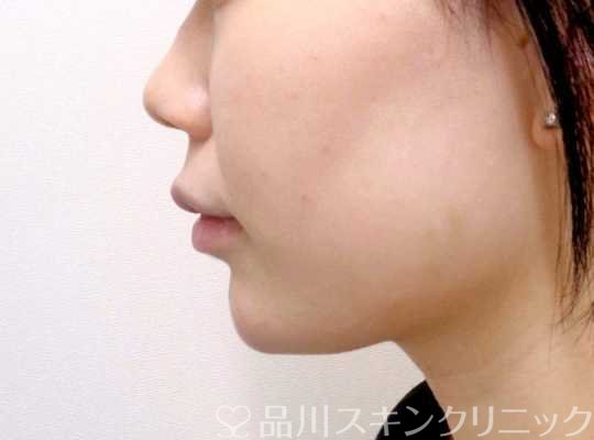 症例NO.69194のAFTER写真