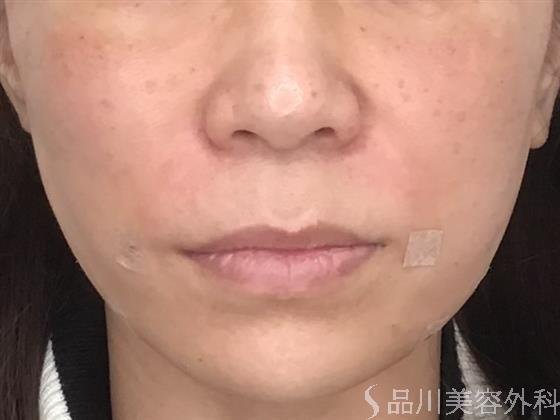 症例NO.59954のAFTER写真