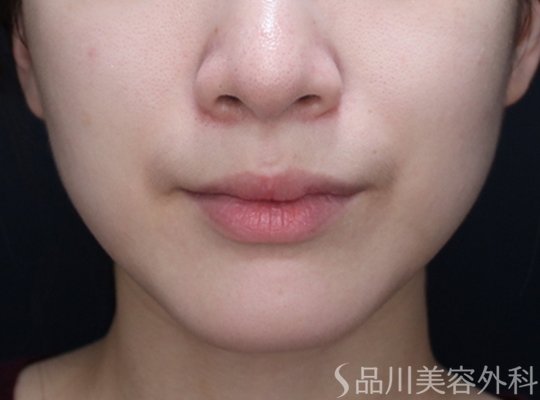 症例NO.73825のBEFORE写真