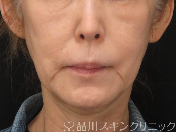 症例NO.69981のBEFORE写真