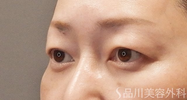 症例NO.74956のAFTER写真