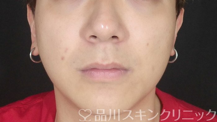 症例NO.71366のBEFORE写真