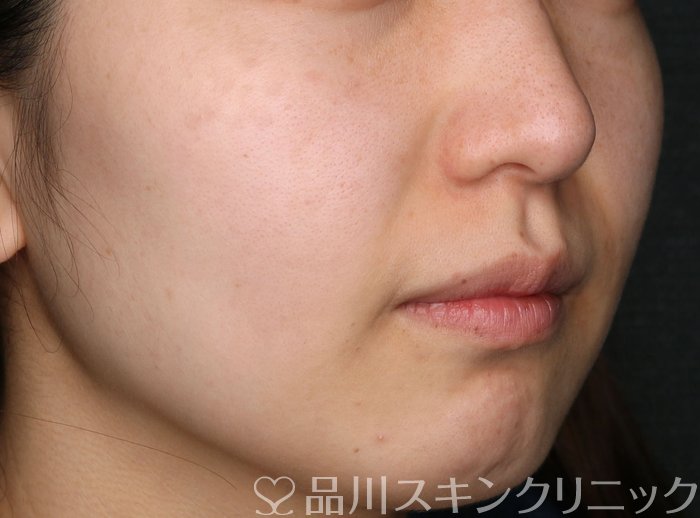 症例NO.69390のAFTER写真