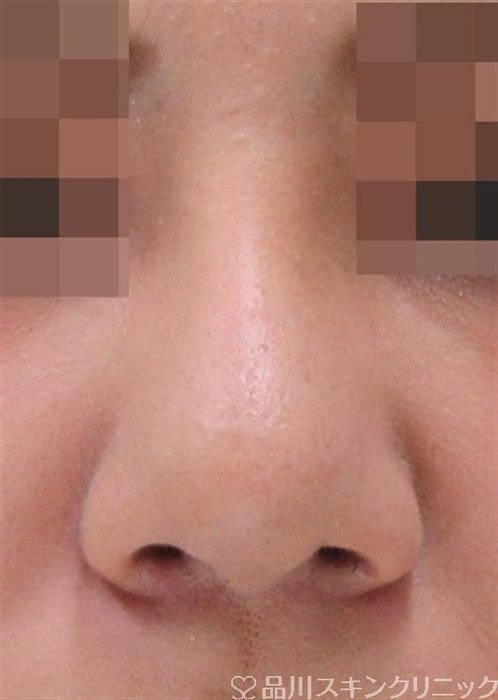症例NO.32660のAFTER写真