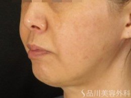 症例NO.70996のBEFORE写真