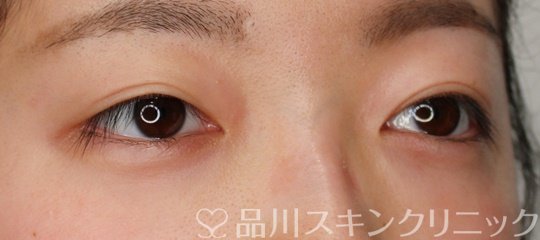 症例NO.70591のBEFORE写真
