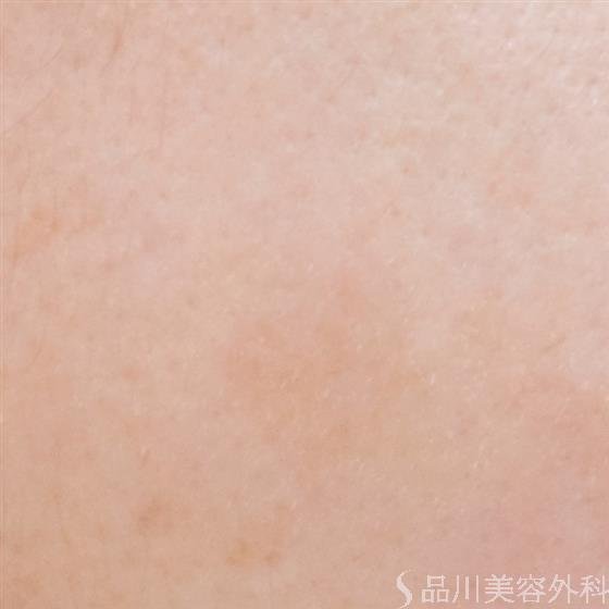 症例NO.58625のAFTER写真