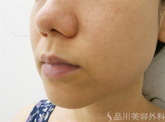 症例NO.14173のAFTER写真