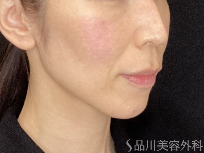 症例NO.72126のBEFORE写真