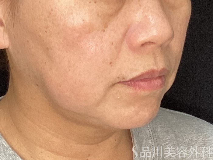 症例NO.72610のBEFORE写真