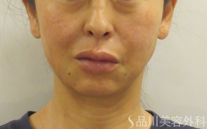 症例NO.71805のAFTER写真