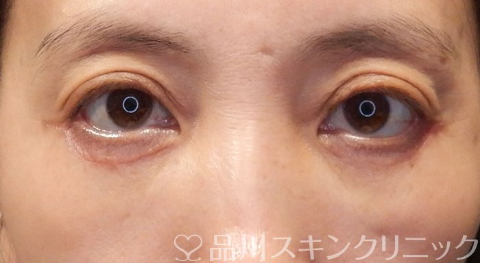 症例NO.70660のAFTER写真