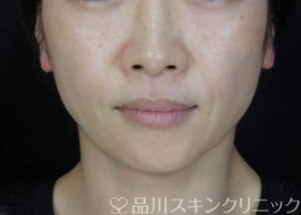 症例NO.72072のBEFORE写真