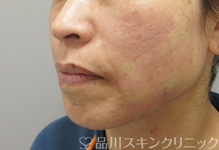症例NO.69810のAFTER写真