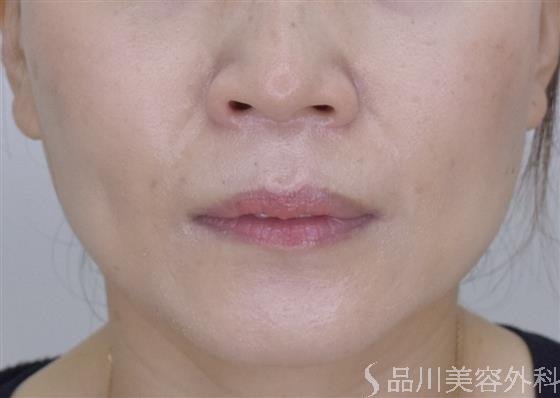 症例NO.51125のAFTER写真