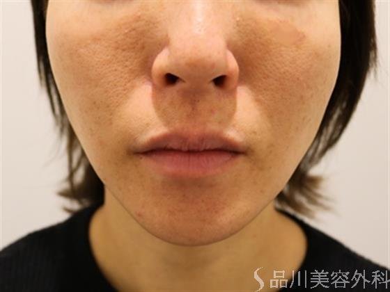 症例NO.38245のAFTER写真