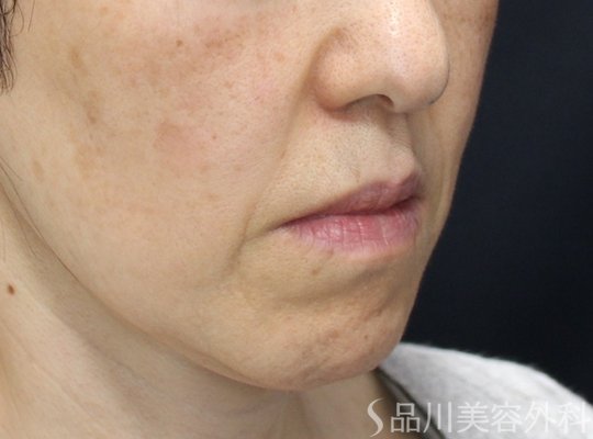 症例NO.75262のBEFORE写真