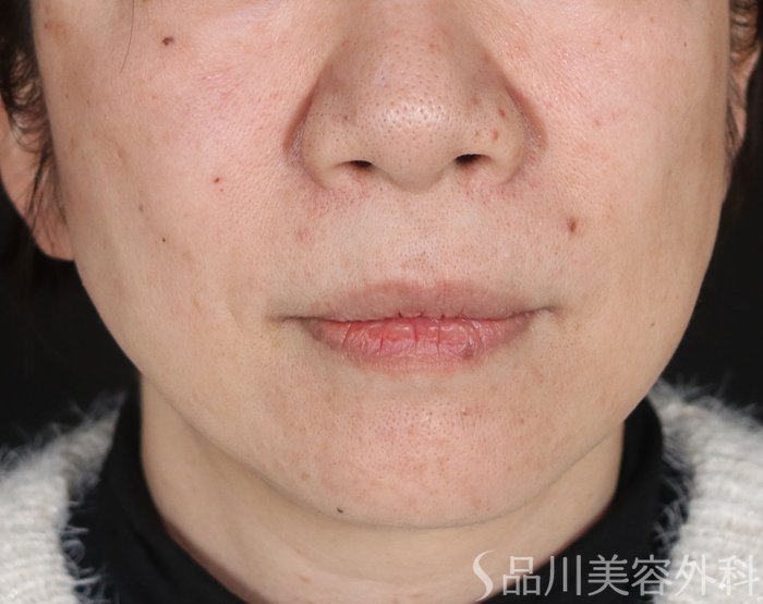 症例NO.72575のAFTER写真