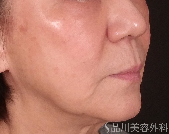 症例NO.69847のBEFORE写真