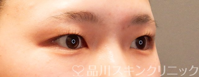 症例NO.70028のBEFORE写真