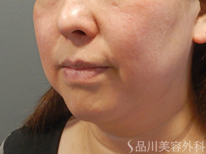 症例NO.69469のBEFORE写真