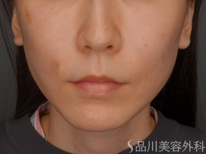 症例NO.73721のAFTER写真