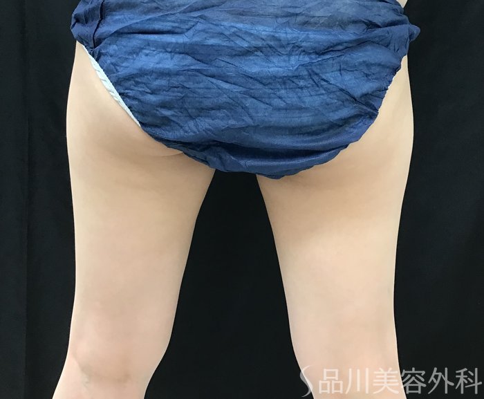 症例NO.68159のAFTER写真