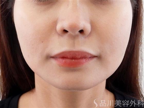 症例NO.61911のAFTER写真